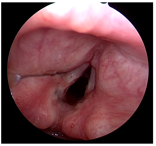 Endoscopic view consistent with unilateral vocal cord paralysis